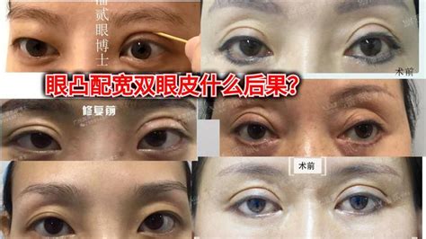 眼球突出面相|【眼睛凸 面相】眼睛凸面相：一探「凸眼」特質者的。